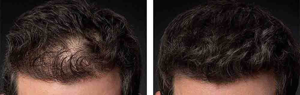 meilleure poudre densifiante cheveux fibre capillaire anti calvitie